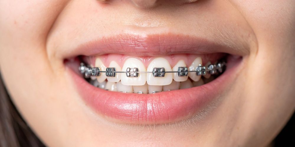 Traditional braces comparison