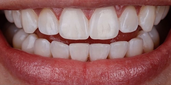 After treatment 1