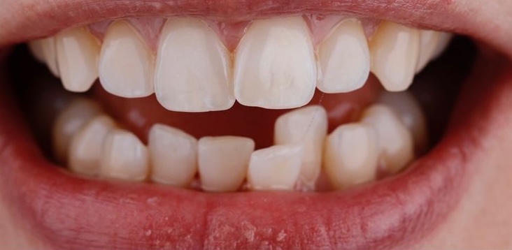 Before treatment 1