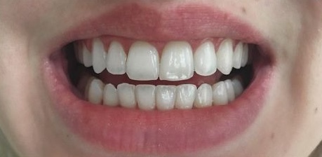 After treatment 2