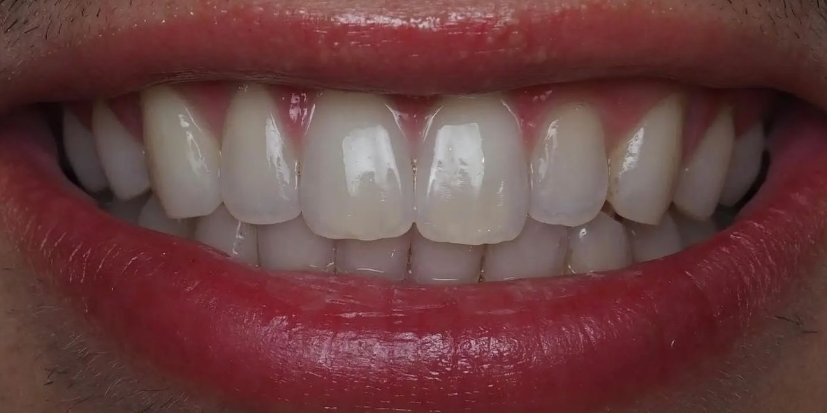 After treatment 6