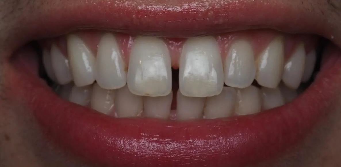 Before treatment 6
