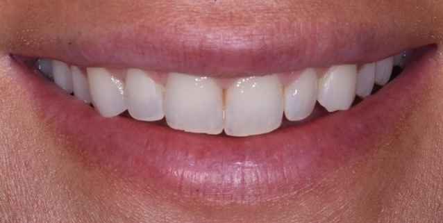 Pre-Treatment