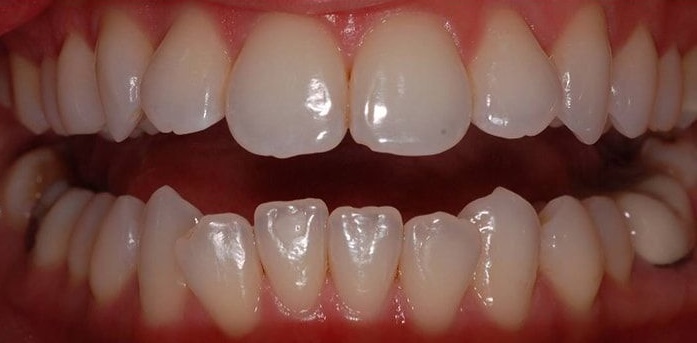 Pre-Treatment