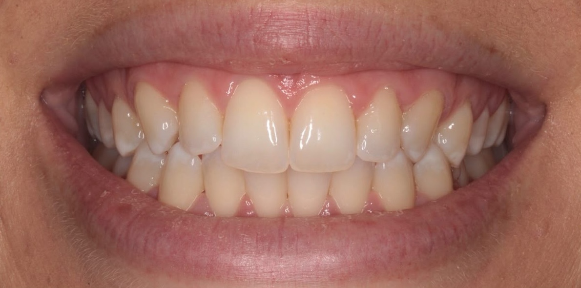 Pre-Treatment