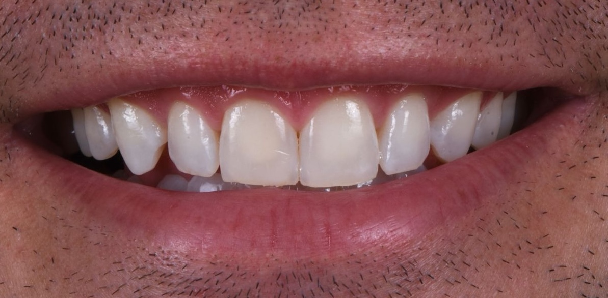 Pre-Treatment