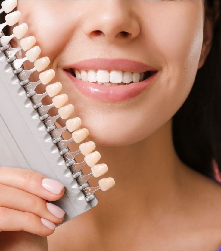 Dental veneers